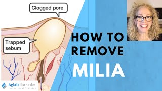 HOW TO REMOVE A MILIA STEP BY STEP  NATURALLY [upl. by Haeckel]