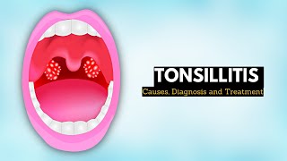 When Should You Remove Your Tonsils  The Doctors [upl. by Ruy]