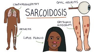 Understanding Sarcoidosis A Visual Guide for Students [upl. by Namilus884]