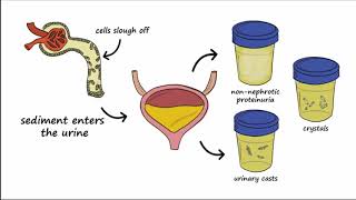 Lupus Nephritis  A to Z Guide [upl. by Venn]