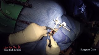 Overview Of Lumbar Disc Replacement Surgery With The M6L [upl. by Maye]