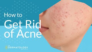 Acne Treatment  Explained by Dermatologist [upl. by Ahsaetan292]