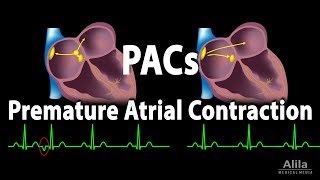 Atrial Fibrillation Afib  EKG ECG Interpretation [upl. by Adran]