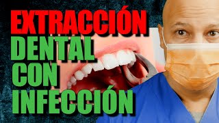 EXTRACCION DENTAL con INFECCION 👈 [upl. by Emiline]