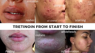 TRETINOIN BEFORE AND AFTER  FULL TRETINOIN EXPERIENCE my journey from start to end Adult Acne [upl. by Margaretha]