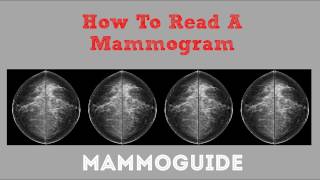 How To Read A Mammogram [upl. by Arreyt941]