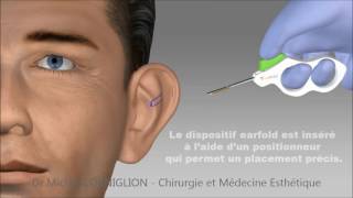 Earfold  une technique non chirurgicale pour les oreilles décollées  Dr Corniglion [upl. by Svensen]