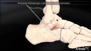 Instabilité de la cheville  ligamentoplastie sous arthroscopie [upl. by Lukey629]