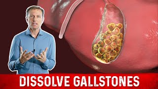 What Causes Gallstones amp How to Treat Them – DrBerg [upl. by Labotsirc]