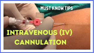 INTRAVENOUS IV CANNULATION in 5 mins How to insert [upl. by Ginger]