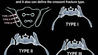 Crescent Fracture Of The Pelvis  Everything You Need To Know  Dr Nabil Ebraheim [upl. by Allain]