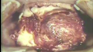 Removal of Large Ameloblastoma of Mandible [upl. by Kurtz809]