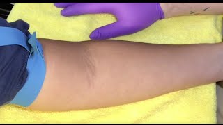 Tips For Locating Difficult Veins [upl. by Eliam239]